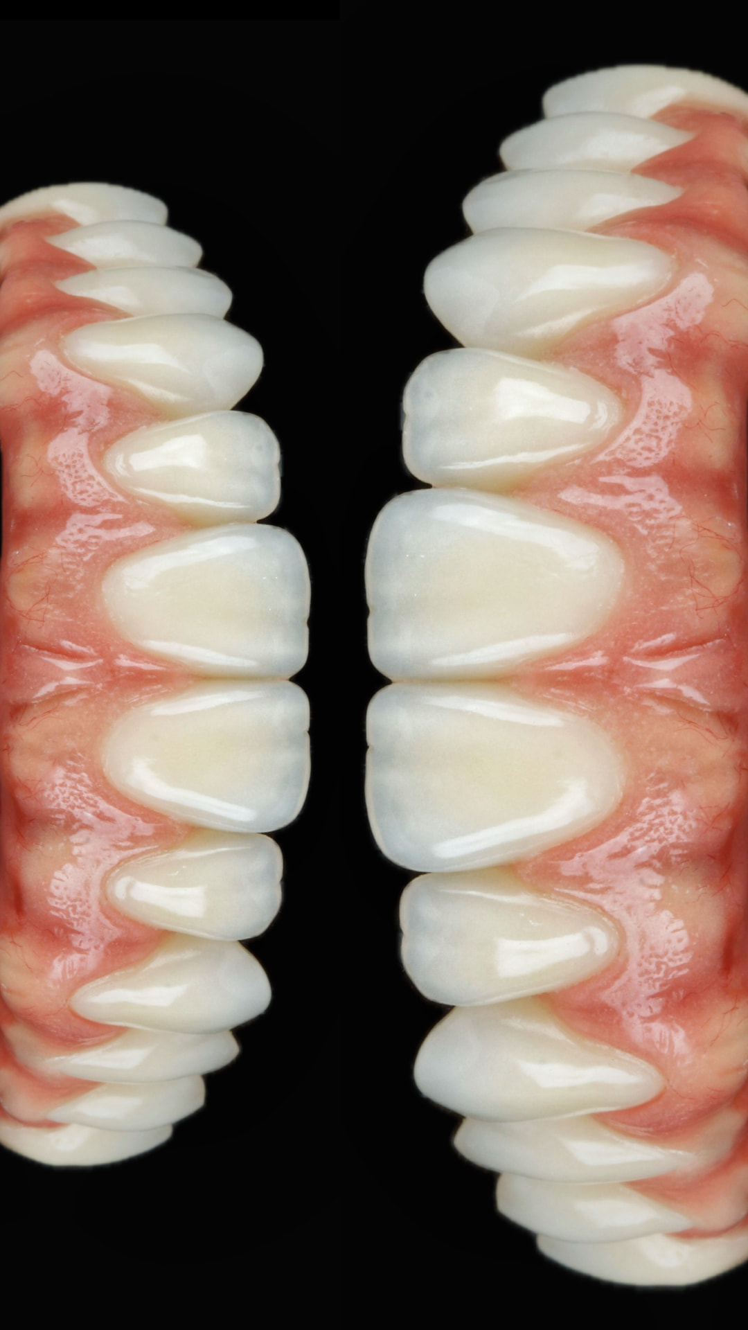 Transição gengival — textura e volume