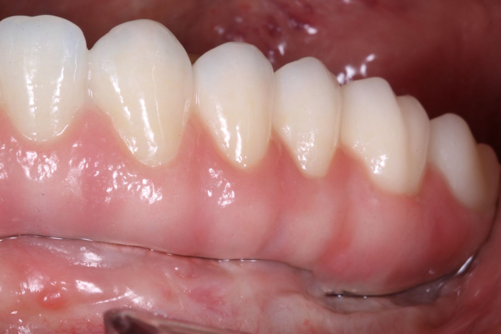 Prova em cera caracterizada com integração natural entre dentes e gengiva